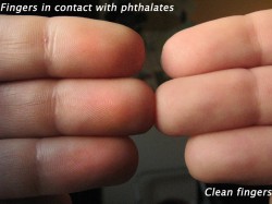 Fingers on the left show a mild chemical burn from Phthalates